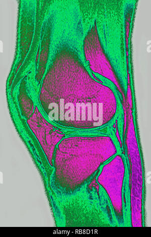 Ginocchio normale MRI Foto Stock