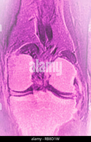 Ginocchio normale MRI Foto Stock