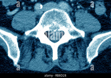 La sindrome di coda di cavallo Foto Stock