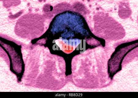 La sindrome di coda di cavallo Foto Stock