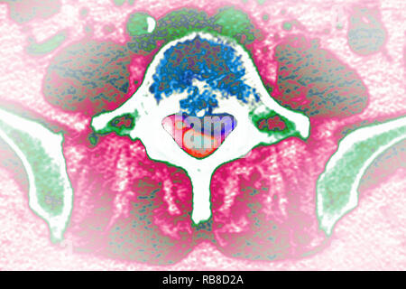 La sindrome di coda di cavallo Foto Stock