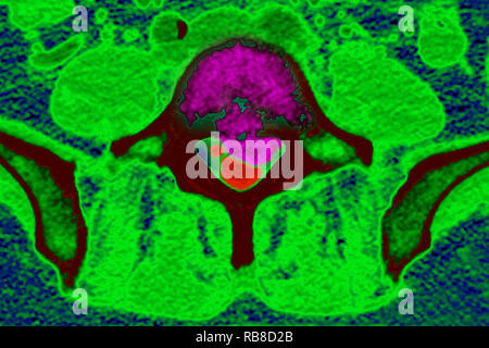 La sindrome di coda di cavallo Foto Stock