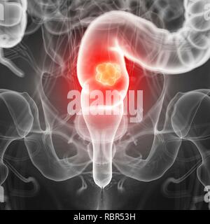 Illustrazione del cancro rettale. Foto Stock