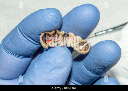 Restauro dentale di marcio le radici dei denti con corone in ceramica. cast posti odontoiatria Foto Stock