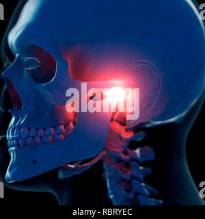 Illustrazione di un doloroso articolazione temporomandibolare. Foto Stock