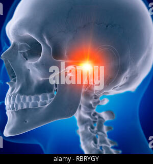 Illustrazione di un doloroso articolazione temporomandibolare. Foto Stock