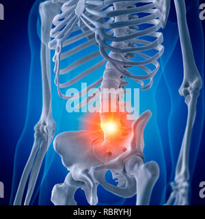 Illustrazione di un doloroso lombare della colonna vertebrale. Foto Stock