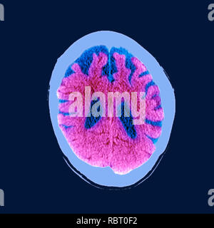 Cervello nella demenza. Colorato la tomografia computerizzata (CT) scansione di una sezione attraverso il cervello di un 89-anno-vecchio paziente di sesso maschile con demenza. Il cervello ha atrophied (ridotto), rappresentata dall'allargamento dei ventricoli centrali (blu scuro) e intaccature profonde intorno al cervello i bordi. Foto Stock