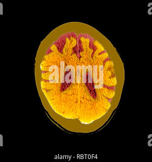 Cervello nella demenza. Colorato la tomografia computerizzata (CT) scansione di una sezione attraverso il cervello di un 89-anno-vecchio paziente di sesso maschile con demenza. Il cervello ha atrophied (ridotto), rappresentata dall'allargamento dei ventricoli centrali (rosso scuro) e intaccature profonde intorno al cervello i bordi. Foto Stock