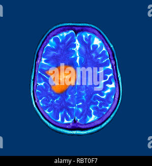 Il glioblastoma cancro al cervello. Colorato la tomografia computerizzata (CT) scansione di una sezione attraverso il cervello di un 84-anno-vecchio paziente femmina con glioblastoma (scuro, a sinistra). Il glioblastoma è la più aggressiva forma di cancro al cervello. Il trattamento consiste in chirurgia, dopo di che la chemioterapia e radioterapia sono utilizzati. Tuttavia, il cancro di solito si ripresenta nonostante il trattamento e la maggior lunghezza comune di sopravvivenza dopo la diagnosi è di 12-15 mesi. Senza trattamento, la sopravvivenza è tipicamente di 3 mesi. Foto Stock