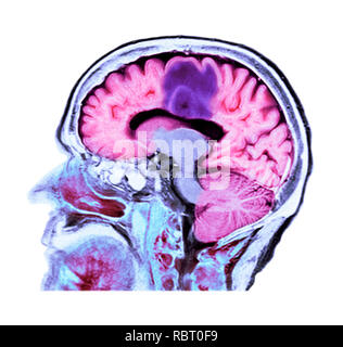 Il glioblastoma cancro al cervello. Colorato la tomografia computerizzata (CT) scansione di una sezione attraverso il cervello di un 84-anno-vecchio paziente femmina con glioblastoma (scuro, alto). Il glioblastoma è la più aggressiva forma di cancro al cervello. Il trattamento consiste in chirurgia, dopo di che la chemioterapia e radioterapia sono utilizzati. Tuttavia, il cancro di solito si ripresenta nonostante il trattamento e la maggior lunghezza comune di sopravvivenza dopo la diagnosi è di 12-15 mesi. Senza trattamento, la sopravvivenza è tipicamente di 3 mesi. Foto Stock