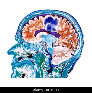 Il glioblastoma cancro al cervello. Colorato la tomografia computerizzata (CT) scansione di una sezione attraverso il cervello di un 84-anno-vecchio paziente femmina con glioblastoma (blu, alto). Il glioblastoma è la più aggressiva forma di cancro al cervello. Il trattamento consiste in chirurgia, dopo di che la chemioterapia e radioterapia sono utilizzati. Tuttavia, il cancro di solito si ripresenta nonostante il trattamento e la maggior lunghezza comune di sopravvivenza dopo la diagnosi è di 12-15 mesi. Senza trattamento, la sopravvivenza è tipicamente di 3 mesi. Foto Stock