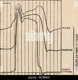 . Dictionnaire de physiologie. Fisiologia. FiG. 20. Â SchÃ©ma indiquant Les relations du tracÃ© ventriculÃ ire [Intracard. pressione) et du choc un cÅnv -(Apex beat), d'aprÃ¨s Roy et Ad AMI. FiG. 21. Â Schema montrant les modifica- zioni de la courbe du choc du cÅur chez le chien sous l'influenza delle variazioni des de la pres- sione exercÃ©e par le bouton du cardiographe sur la paroi ventriculÃ IRE (fig. 13 deUoY et Adami). deux courbes n'ont, versare lui, rien de commun : elles se produisent par onu mÃ©canisme entiÃ¨rement diffÃ©affitto, et ne prÃ©sentent qu'exceptionnellement et accidentellement une c Foto Stock