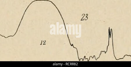 . Dictionnaire de physiologie. Fisiologia. La deglutizione. 7i5 ce sont les libres longitudinales dont la forte eontriiclion surmonte la rÃ©sistance des fibre musculaires et fait cesser l'occlusione. Â Â§ 4. Dcijlulitions rd'pdtccs. Â Tous les phÃ©nomÃ¨nes dÃ©crits jusqu'Ã prÃ©inviato se rap- avvisaglia Ã une dÃ©glutition isolÃ©e. iNous avons vu qu'en moins de 0",1 l'acte principal peut Ãªtre terminÃ©, que le bol est lancÃ© pendant cet intervalle de temps jusqu'au cardia. Nous savons Ã©galement qu'entre le premier mouvement et le inizio de la. Si prega di notare che queste immagini sono estratte dal Foto Stock