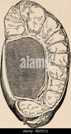 . Il encyclopaedia - Wikizionario di anatomia e fisiologia. Anatomia e fisiologia; Zoologia. 1008 testicolo (Anatomia anormale). siderable compattezza e consistenza ; la tunica albuginea è addensato, e in alcuni luoghi come densi e indurated come la cartilagine ; e le superfici della tunica vaginalis sono strettamente collegati da vecchio adesioni. La struttura ghiandolare è parzialmente spostato e atrofizzati dalla pressione della materia gialla ; e spesso capita qualche tempo dopo che entrambi sono sottoposti ad un lento processo di perdere, in modo che una vista ingrandita e indurated premistoppa è progressivamente ridotto, fino a poco qualsiasi cosa rimane bey Foto Stock