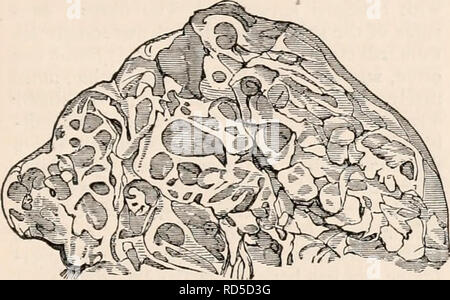 . Il encyclopaedia - Wikizionario di anatomia e fisiologia. Anatomia e fisiologia; Zoologia. Prodotti, accidentale. 133 molti scrittori chirurgico confusi, sotto il nome di erroneo di " exostosis cartilaginei " (erronea, se non per altra ragione, perché la formazione in questione può molla da altri tessuti di osso), con prodotti essenzialmente di carattere diverso e da alcuni altri autori hanno descritto come cancro di colloide. Quando intonso, enchondroma presenta se stesso come un tumore di dimensioni moderate e sferoidali di non-lobulated forma, racchiusi in cellular mem brane-, o (se la molla da osso) in perios- teum, Foto Stock