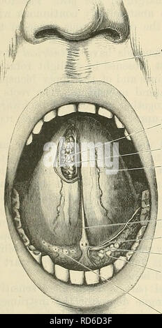 . Cunningham il libro di testo di anatomia. Anatomia. Styloglossus. Meno navi alveolare e nervose del nervo linguale esterna arteria mascellare parte superficiale della ghiandola sottomascellari" condotto sottomascellari parte profonda sottomascellari ipoglosso premistoppa tendere.  arteria linguale/^S? Hyoglossus/^ Mylo-hyoi" tendine Digastric' Genio-hyoid muscolo temporale la linguetta inferiore navi alveolare e nervose esterna arteria mascellare Mylo-hyoid nervo linguale parte profonda della ghiandola sottomascellari sottomascellari condotto v nervo ipoglosso x arteria linguale Digastric Hyoglossus Genio-liyoid Fig. 1083. -Sezione coronale attraverso la tenaglia Foto Stock