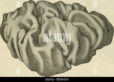 . Cunningham il libro di testo di anatomia. Anatomia. 556 IL SISTEMA NEKVOUS. nel midollo sono meno olivary nucleo e i due accessorio olivary nuclei. Il nucleo olivaris inferiore è la massa di sostanza grigia che produce il rigonfiamento noto come l'olio d'oliva, e costituisce un molto sorprendente oggetto in trans- sezioni in versi attraverso questa regione. Esso presenta l'aspetto di una ondulata spessa o linea ondulata di materia grigia, ripiegato su se stesso in modo da racchiudere uno spazio riempito con la sostanza bianca. Essa è in realtà una lamina spiegazzato disposti in una borsa in modo simile con un aperto bocca o fessura, Foto Stock