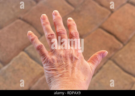 Queste sono le mani di una donna anziana con il dito il dolore Foto Stock