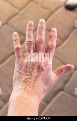 Queste sono le mani di una donna anziana con il dito il dolore Foto Stock