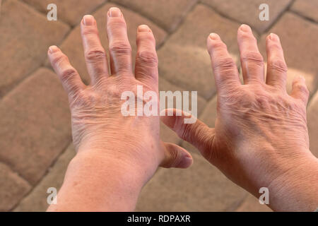 Queste sono le mani di una donna anziana con il dito il dolore Foto Stock