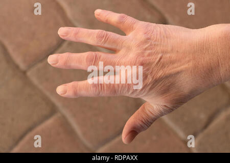 Queste sono le mani di una donna anziana con il dito il dolore Foto Stock