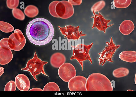 Acanthocytes. Illustrazione di una anormale cellule rosse del sangue noto come stimolare cellule o acanthocytes. Le cellule rosse del sangue con questo aspetto può verificarsi in associazione con una rara condizione chiamata abetalipoproteinemia, così come nelle malattie del fegato, Huntington acanthocytosis, ereditato diversi disturbi neurologici, anoressia nervosa, ipotiroidismo, alcolismo e altri disturbi. Le Cellule deformate sono distrutti prematuramente, principalmente nella milza, causando anemia. Un linfocita di piccole dimensioni è disegnata per il confronto delle dimensioni. Foto Stock