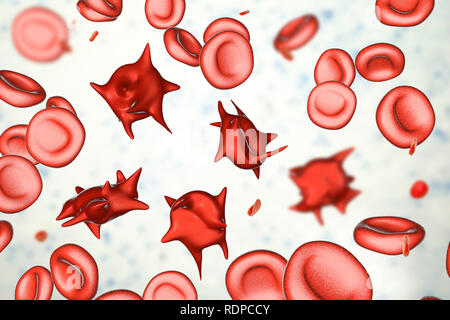 Acanthocytes. Illustrazione di una anormale cellule rosse del sangue noto come stimolare cellule o acanthocytes. Le cellule rosse del sangue con questo aspetto può verificarsi in associazione con una rara condizione chiamata abetalipoproteinemia, così come nelle malattie del fegato, Huntington acanthocytosis, ereditato diversi disturbi neurologici, anoressia nervosa, ipotiroidismo, alcolismo e altri disturbi. Le Cellule deformate sono distrutti prematuramente, principalmente nella milza, causando anemia. Foto Stock