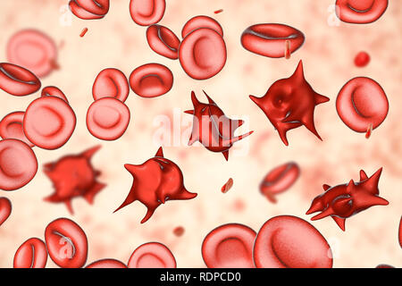 Acanthocytes. Illustrazione di una anormale cellule rosse del sangue noto come stimolare cellule o acanthocytes. Le cellule rosse del sangue con questo aspetto può verificarsi in associazione con una rara condizione chiamata abetalipoproteinemia, così come nelle malattie del fegato, Huntington acanthocytosis, ereditato diversi disturbi neurologici, anoressia nervosa, ipotiroidismo, alcolismo e altri disturbi. Le Cellule deformate sono distrutti prematuramente, principalmente nella milza, causando anemia. Foto Stock