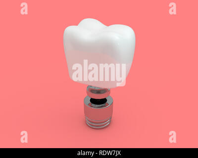 Impianto dentale dentista, dente formato, materie plastiche, uomo, trattamento dei denti 3D rendering Foto Stock