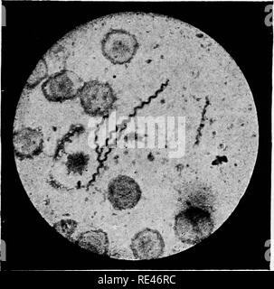 . Clinica e batteriologia ematologia per professionisti. Batteriologia; ematologia. L'esame batteriologico del sangue ho39 I e 2. Streptococchi e stafilococchi.-Questi si trovano nei casi di Setticemia, piemia, colite endocardite, ecc.; essi indicano sempre una pessima prognosi. Il capo dell' importanza che attribuisce alla scoperta di questi organismi è che è assolutamente si assesta la diagnosi (sempre a condizione che non vi siano errori nella tecnica), e che indica se l'uso di antistrepto- coccic siero è consigliabile o non; è inutile in casi di septi- c Foto Stock