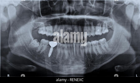 Vista panoramica immagine in bianco e nero apparecchiature odontoiatriche a raggi x di adulti con un unico impianto dentale. Roentgen denti mascellare superiore e inferiore. Colpo negativo della digital pic Foto Stock