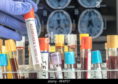 Scienziato detiene il campione di sangue da analizzare Porre rimedio contro il morbo di Alzheimer, immagine concettuale Foto Stock