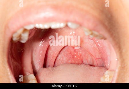 Mal di gola con la gola gonfia. Primo piano a bocca aperta con il posteriore della parete faringea rigonfiamento e ugola e tonsille. Influenza dei follicoli piliferi nella sezione posteriore Foto Stock