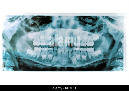 X ray delle ganasce isolato su bianco Foto Stock