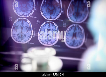 Analisi scientifica della malattia di Alzheimer in ospedale, immagine concettuale Foto Stock