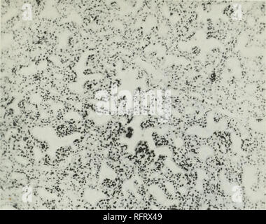 . Il carcinoma della tiroide in salmonoid pesci. Il cancro; il gozzo; tiroide; trota. Boll. U. S. B. F. 1912. Piastra CVIII.. Montare;. Noi.-Sezione vicino alla periferia della tiroide ingrandita del cane 18. Il processo è meno intenso quello vicino al centro. Come illustrato nella figura 117 e 119. Epitelio colonnare, segnato crescite papillare in alveoli distorto. Colloid assente. X160.. Si prega di notare che queste immagini vengono estratte dalla pagina sottoposta a scansione di immagini che possono essere state migliorate digitalmente per la leggibilità - Colorazione e aspetto di queste illustrazioni potrebbero non perfettamente assomigliano al lavoro originale. Gayl Foto Stock