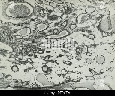 . Il carcinoma della tiroide in salmonoid pesci. Il cancro; il gozzo; tiroide; trota. Boll. U. S. B. F. 1912. Piastra XCI.. Fic. 84.-Sezione di wild Wisconsin trota di fiume. Materie fegato alimentazione di dodici mesi. Focal ikvclopment caroiuonia di tlie tliyroid. Piccolo gruppo di follicoli con epitelio colonnare. Colloide ridotta. Hypentiuia atiout fullicks, al perimetro inalterato il normale follicoli della tiroide. X86.. Si prega di notare che queste immagini vengono estratte dalla pagina sottoposta a scansione di immagini che possono essere state migliorate digitalmente per la leggibilità - Colorazione e aspetto di queste illustrazioni potrebbero non perfettamente resembl Foto Stock