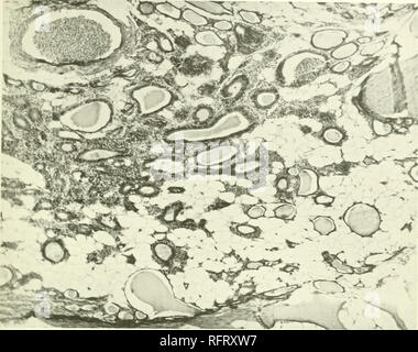 . Il carcinoma della tiroide in salmonoid pesci. Trote; tiroide; cancro gozzo. Boll. U. S. B. F. 1912. Piastra XCI.. Kl&LT;;. 84.-Sezione di wild Wisconsin trota di fiume. Fegato grezza feedinn IJ mesi, hocal developnitnl CMrcinoni.i della tiroide. Piccolo gruppo di follicoli con epitelio colonnare. Colloide ridotta. Hypersemia circa i follicoli. A neripherv normale tiroide inalterati i follicoli. X86.. Si prega di notare che queste immagini vengono estratte dalla pagina sottoposta a scansione di immagini che possono essere state migliorate digitalmente per la leggibilità - Colorazione e aspetto di queste illustrazioni potrebbero non perfettamente res Foto Stock