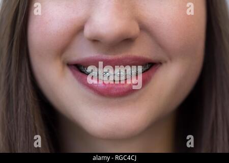 Close-up di sorridente ragazza adolescente con le bretelle Foto Stock