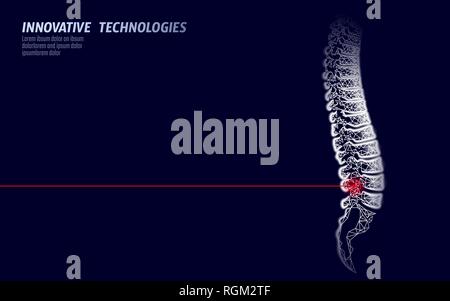 Fisioterapia Laser colonna vertebrale umana pregiudizio. Area di dolore operazione di chirurgia moderna medicina di lombo di bassa tecnologia poli triangoli 3D render femmina ernia indietro Illustrazione Vettoriale