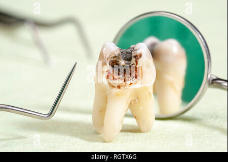 Estratto il dente molare con la carie e amalgama Foto Stock