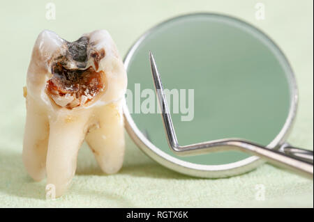 Estratto il dente molare con la carie e amalgama Foto Stock