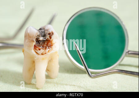 Estratto il dente molare con la carie e amalgama Foto Stock