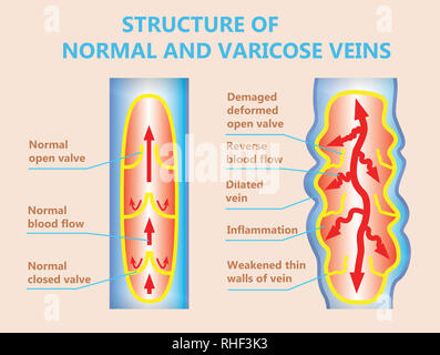 Le vene varicose e le vene normale Foto Stock