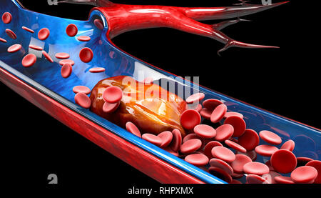 3d illustrazione di trombosi venosa profonda o coaguli di sangue. L'embolia Foto Stock