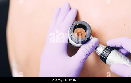 Il dermatologo esaminando mole sul retro femmina utilizzando dermatoscope Foto Stock