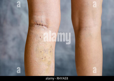 Womans gambe dopo chirurgia dele varici, con visibile suture chirurgiche (punti) e ferite su una gamba. Trattamento curativo, procedimenti estetici, thr Foto Stock