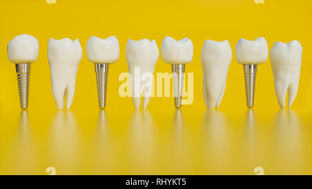 Dente impianto umano. Denti umani o protesi su sfondo giallo -- 3d rendering Foto Stock