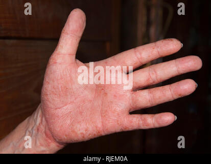 Neurodermatite acuta rispettivamente eczema atopico Foto Stock